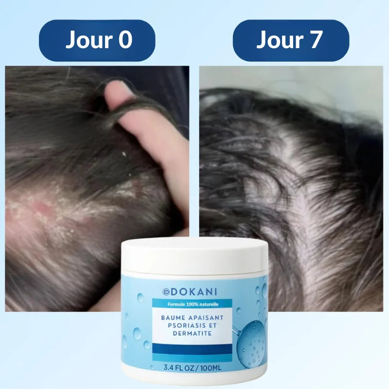 Baume apaisant psoriasis & dermatite